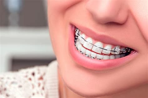 Tipos De Brackets Zafiro Cl Nica Dental Pablo Fos