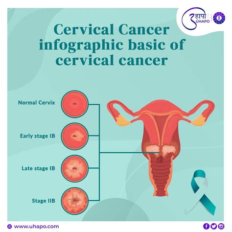 Cervical Cancer Demystified A Comprehensive Guide Artofit