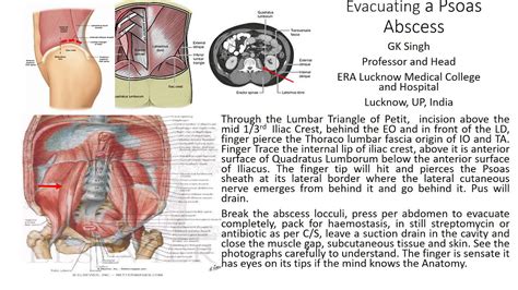 Psoas Sign Video Comprendre Et Soulager La Tendinite Du Psoas Guide
