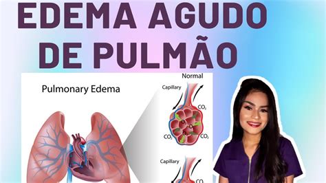 EDEMA AGUDO DE PULMÃO ENFERMAGEM Aline Chaves YouTube