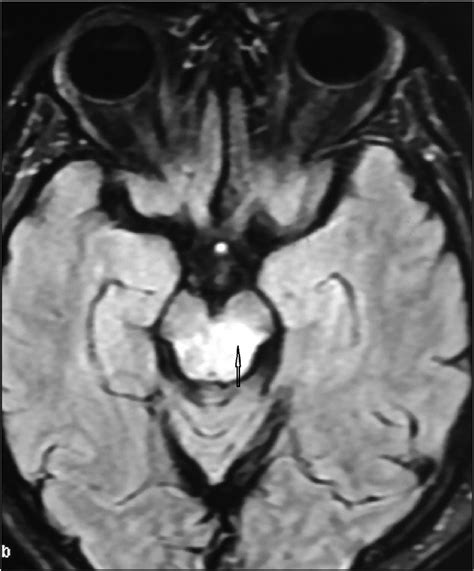 Mri Of Brain Axial Section Showing Confluent T2 Hyperintensities In