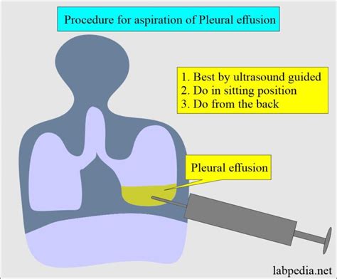 Pleural Fluid Analysis and Aspiration Procedure (Thoracentesis)