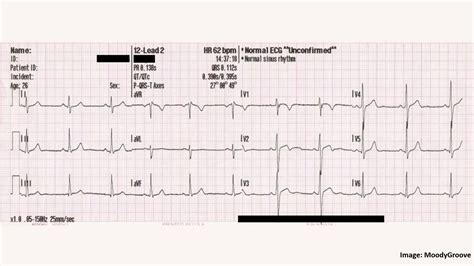 What's an Electrocardiogram? | Research Matters