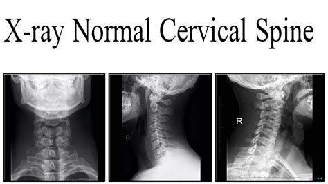 Cervical spine abnormal x ray - hitshost