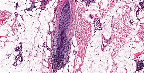 Scarring Alopecia Histology