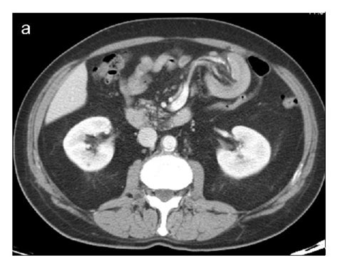 Enteroenteric Ileoileal Intussusception Caused By Lymphoma Axial Ct Download Scientific