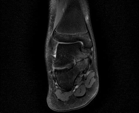 Talocalcaneal Coalition Mri