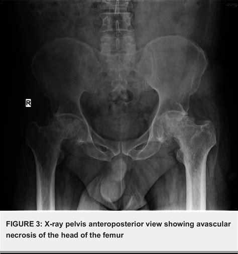 Figure From Musculoskeletal Manifestations Of Sickle Cell Disease A