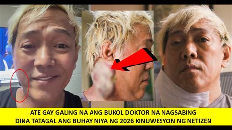 ATE GAY STAGE 4 CANSER LUMIIT NA ANG BUKOL DOKTOR NA TUMINGIN NUNG UNA