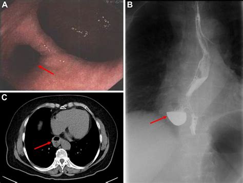 A Upper Gastrointestinal Endoscopy Showed The Diverticulum 30 Cm From