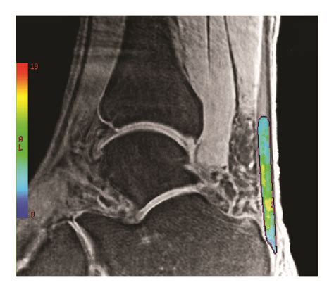 Ute T Mapping On Diseased A And Healthy B Achilles Tendons Of A