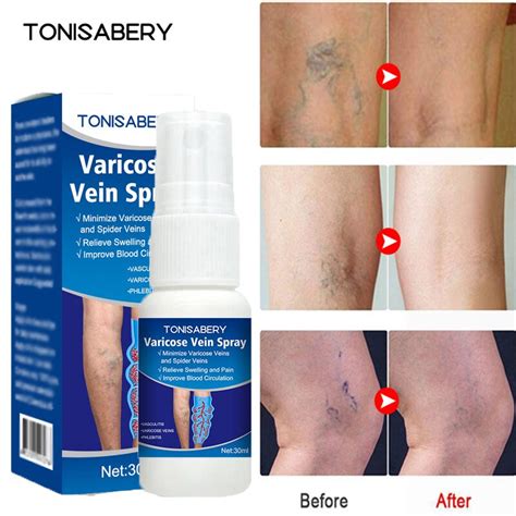 Varicose Vein Treatment Spray Vasculitis Phlebitis Spider Relief