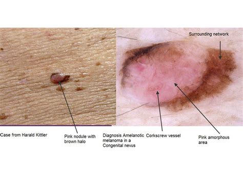 Dermoscopy Made Simple Amelanotic Melanoma