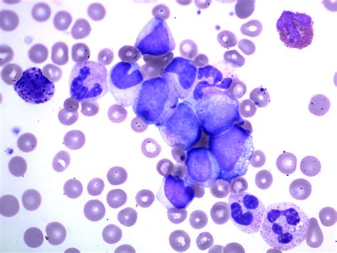 Pathology Outlines Chronic Myeloid Leukemia CML BCR ABL1 Positive