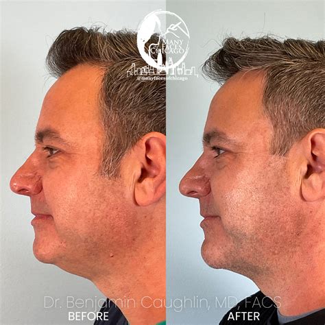 Combination Of Buccal Fat Removal Jawline Sculpting Chin Implant