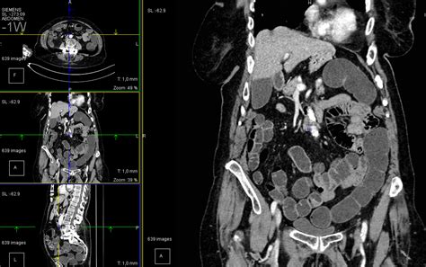 Scanner Digestif Soci T D Imagerie M Dicale Bois Bernard