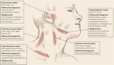 Persistent Generalized Lymphadenopathy Definition Causes Symptoms