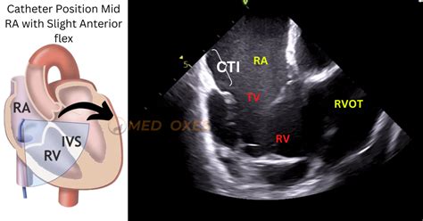 Intracardiac Echocardiography Catheter Manipulation Technique | MedFoxes