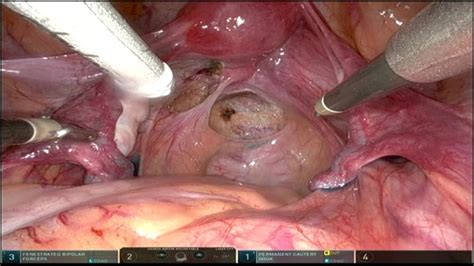 The Presacral Neurectomy SurgeryU By AAGL