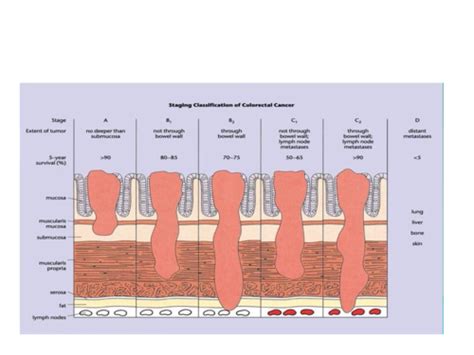 Colorectal Cancer Flashcards Quizlet