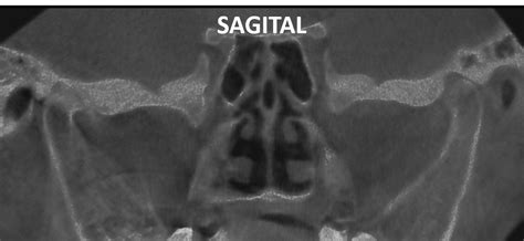 Anquilosis de la ATM Dento Metric Radiología Dental Oral y