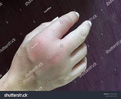 Infection After Bee Sting Swollen Hand Stock Photo Edit Now 1195470364