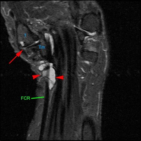 Flexor Carpi Radialis Tendinopathy