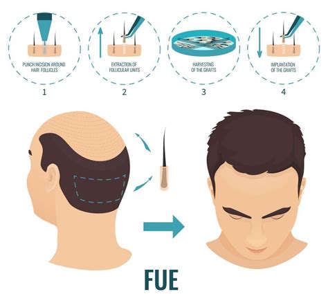 Sapphire Fue Hair Transplant Este Expert