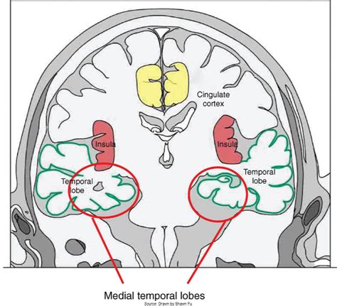 Structural and Genetic Temporal Lobe Epilepsy – Hippocampal Sclerosis