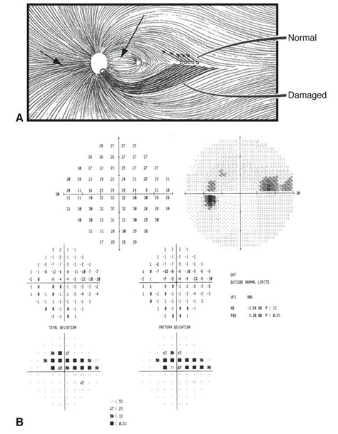 Visual field patterns in optic neuropathy - American Academy of ...