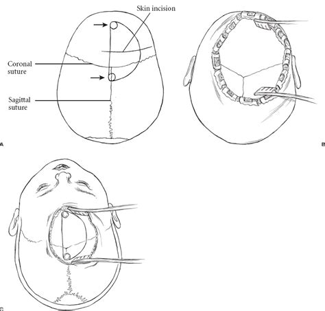 Corpus Callosotomy | Neupsy Key