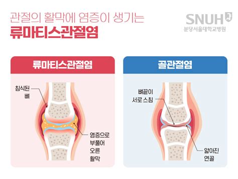 건강상식 분당서울대학교병원