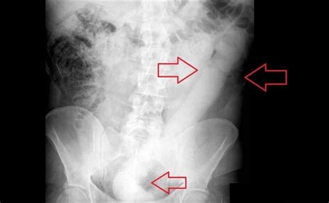 Médicos inventan una herramienta para extraer un dildo de cm del recto de un paciente Los