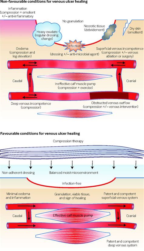 Diagnosis And Management Of Venous Leg Ulcers The Bmj