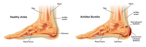 Bursite d Achille Symptômes causes traitement par les orthèses de