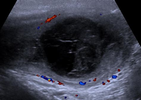 Epididymal Haematoma Multiparametric Ultrasonographic Findings Eurorad