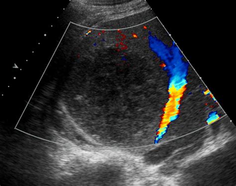 Liver Atlas Diagnosis Abscess Amebic