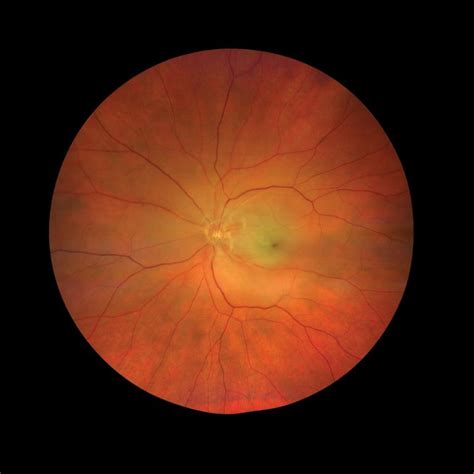 Central Retinal Artery Occlusion Os Crao