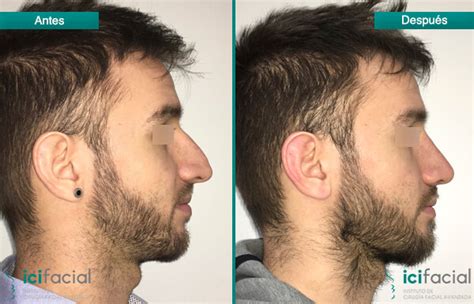 Fotos Rinoplastia Antes Y Despu S Del Dr Mac A De Icifacial En Madrid