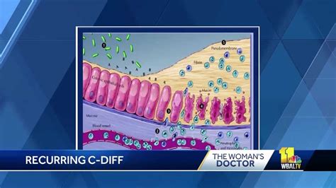 Woman's Doctor: Recurring C. diff treatable with fecal transplant ...