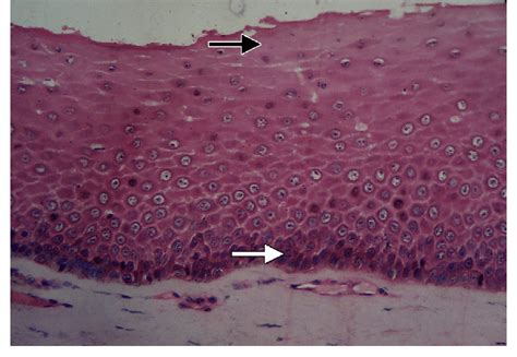 Oral Submucous Fibrosis Histopathology