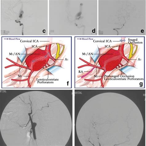 Surgical Management Of Complex Mca Aneurysms Download Table