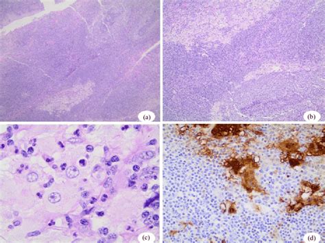 A And B H E Stained Sections Of Tonsil Showing Sheets Of Large