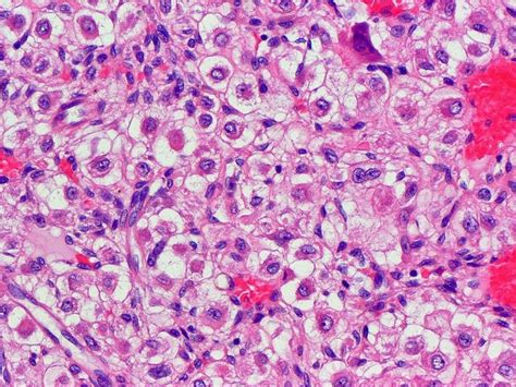 Chondrosarcoma Histology