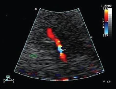 The transcranial color Doppler ultrasound results of the two groups of ...