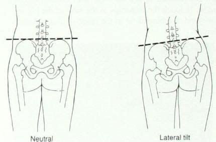 Lateral Pelvic Tilt Muscles | ... muscles. Below are details of the ...