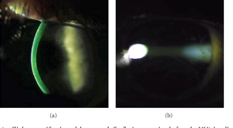 Figure 1 From Safety And Efficacy Of Epithelium On Corneal Collagen