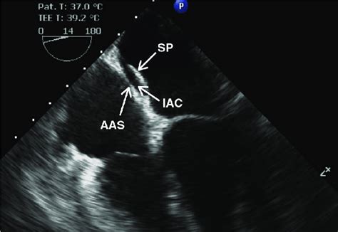 Four Chamber Transesophageal Echocardiographic View Showing A Double