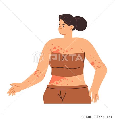 Woman With Rash On Arm Vector Pixta