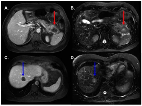 Cancers Free Full Text MRI Based Tumor Necrosis Depiction In